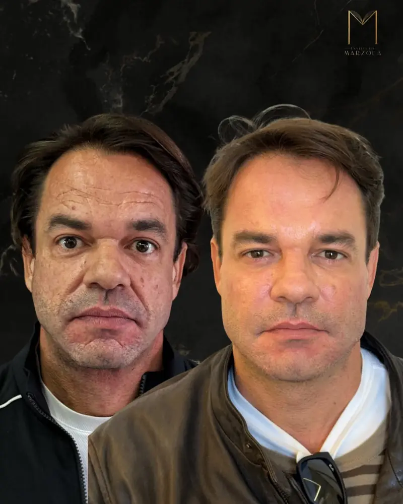 Harmonização facial completa, caso real do Instituto Marzola