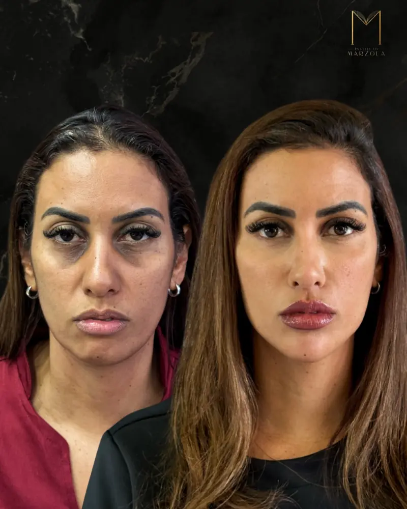 Harmonização facial, antes e depois, caso real do Instituto Marzola