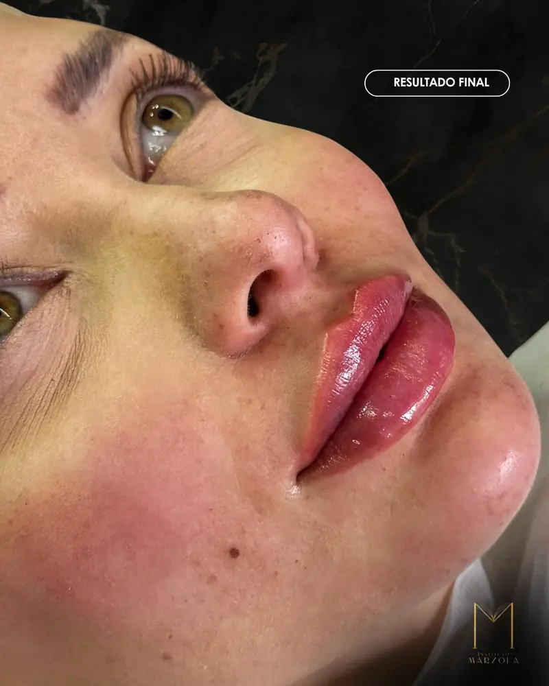 Preenchimento labial, caso real do Instituto Marzola